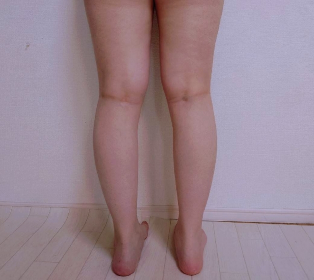 O脚は内ももでは治らない。足首が原因ですの画像
